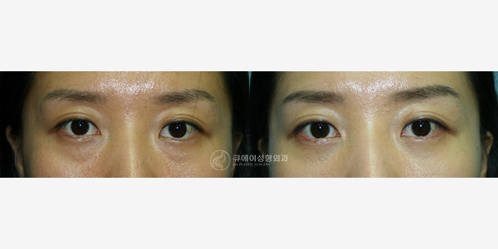 눈 밑 지방 재배치1.jpg